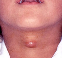 Киста щитовидной железы узловое образование с полостью, заполненной жидкостью